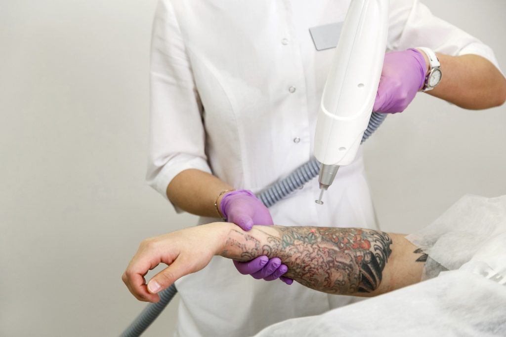 Tattoo Removal: 6 Methods to Consider