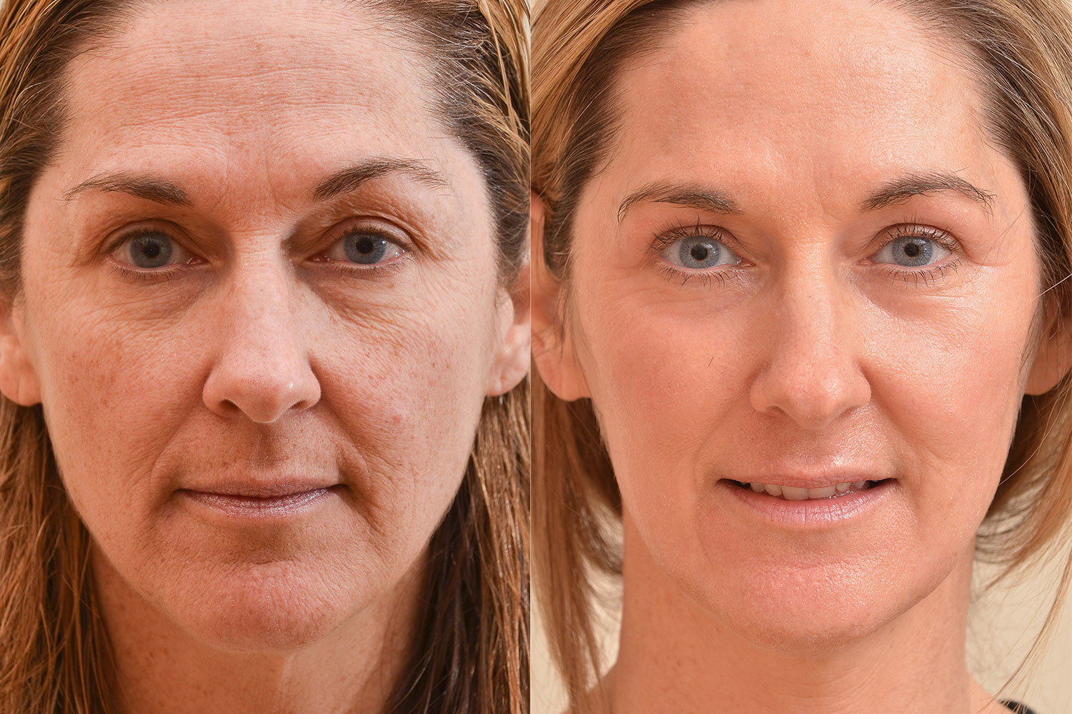 Revitalizing Your Skin: Delving into Skin Resurfacing in Dubai