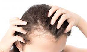 Hair Loss: Causes, Prevention and Treatment Options