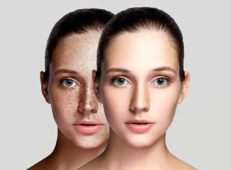 Understanding Pigmentation: Causes, Types, and Effective Treatment Options