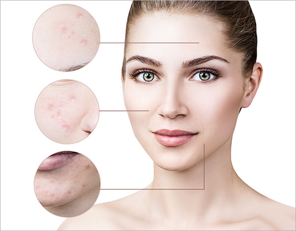 Lifestyle Habits and Acne Scarring: Understanding the Connection and Prevention