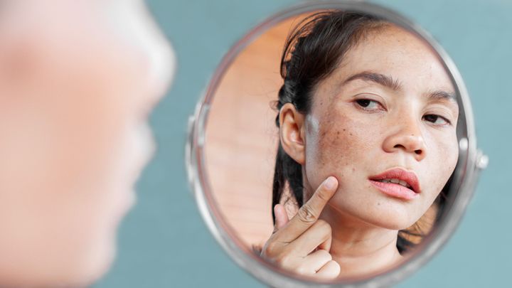 Causes of Hyperpigmentation and How to Prevent It
