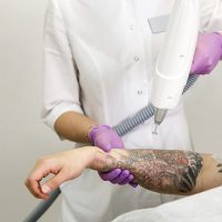 2 Laser Tattoo Removal